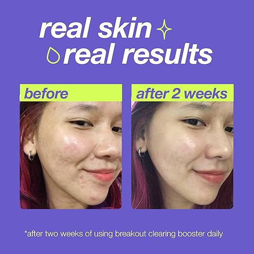 Dermalogica-Breakout-Clearing-Booster-before-after