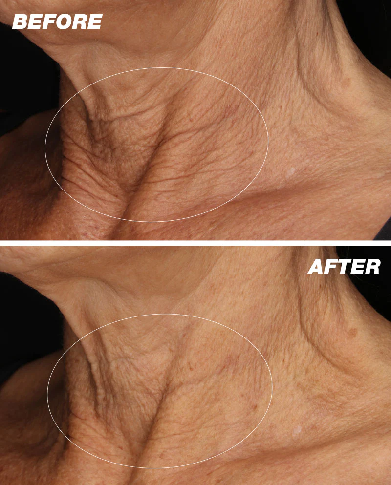 dermalogica-neck-fit-serum-Before-and-After