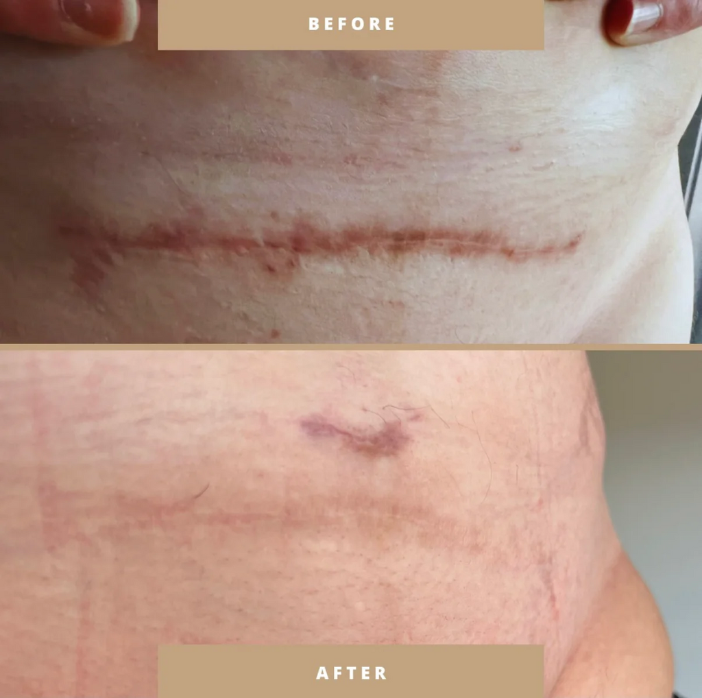 womans-wellness-boutique-csection-recovery-kit-before-after
