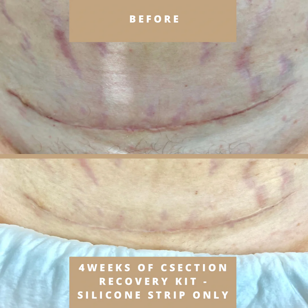 womans-wellness-boutique-csection-recovery-kit-before-and-afters