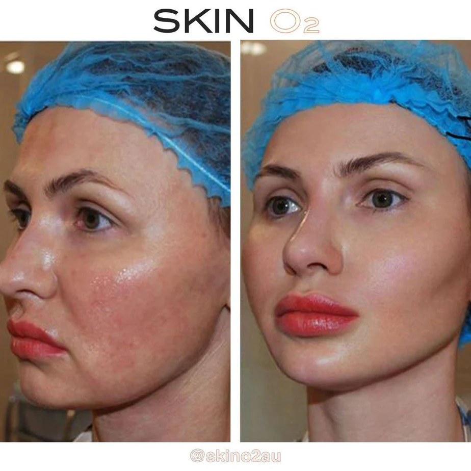Skin O2 Skin Facial Toner + Free Derma Fill Gel