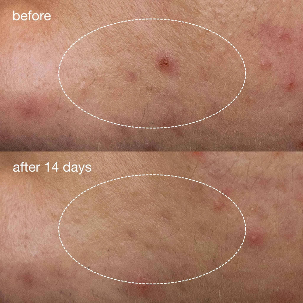 dermalogica-deep-acne-liquid-patches.
