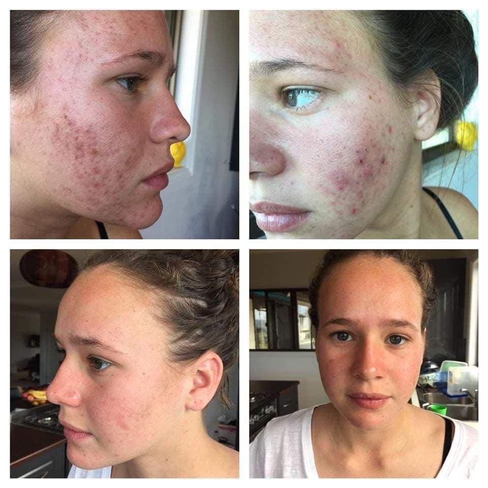 lucim-skincerity-nightly-breathable-mask-before-and-after-acne