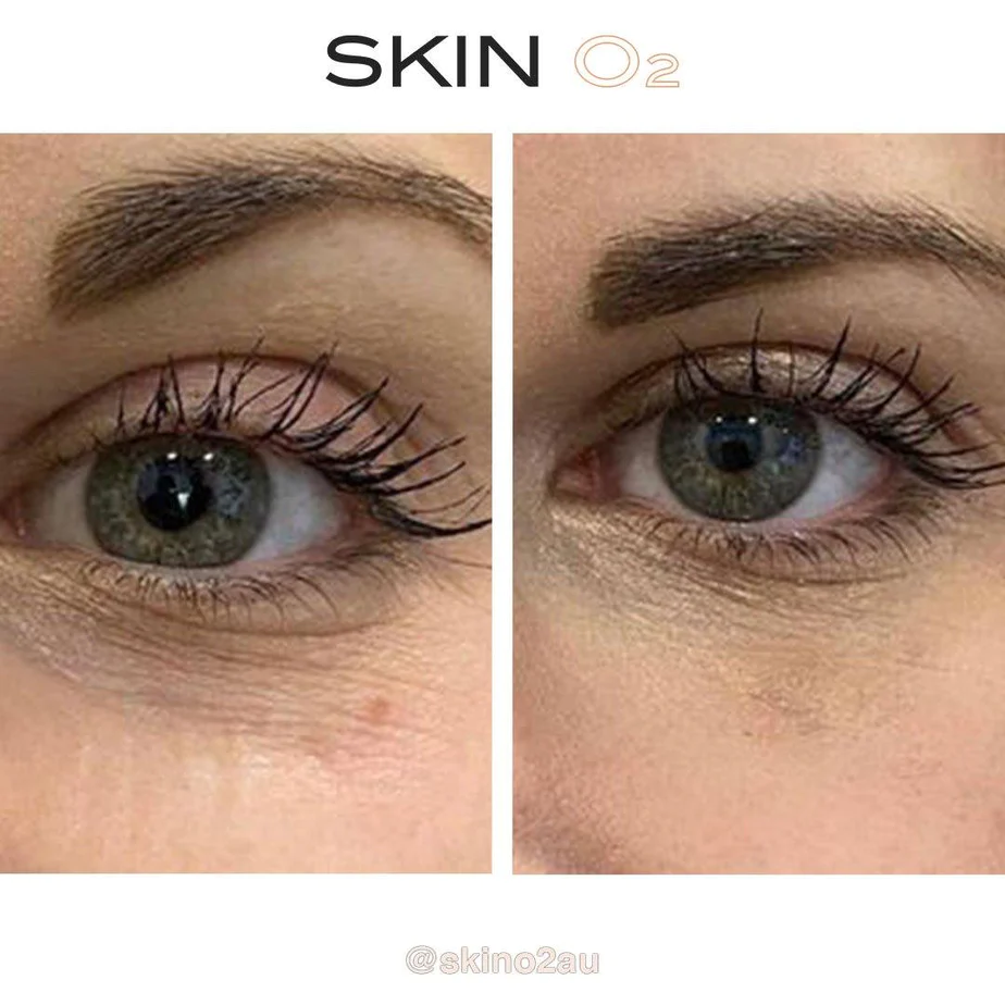 skin-o2-eye-cream-peptide-free-platinum-eyelift-before-after