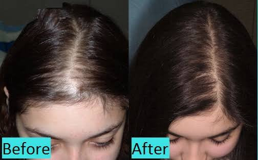 xcellarispro-hair-treatment-before-after
