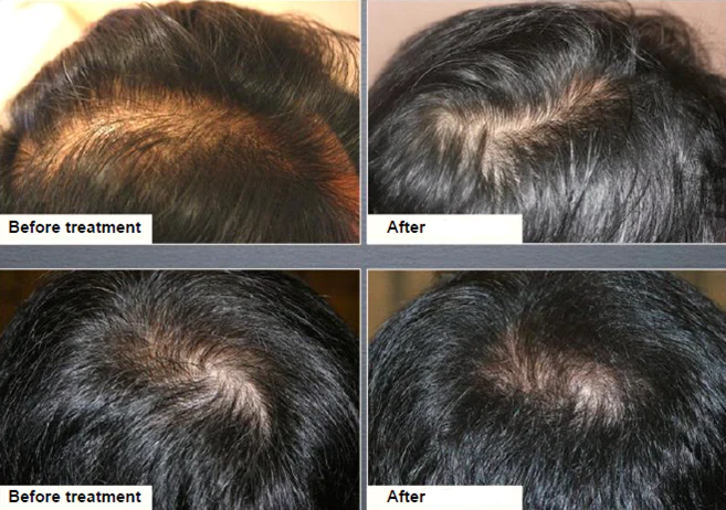 xcellarispro-hair-treatments