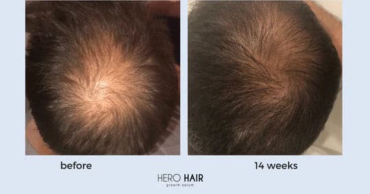 CanGro-Hero-Hair-Growth-Serum-Before-After